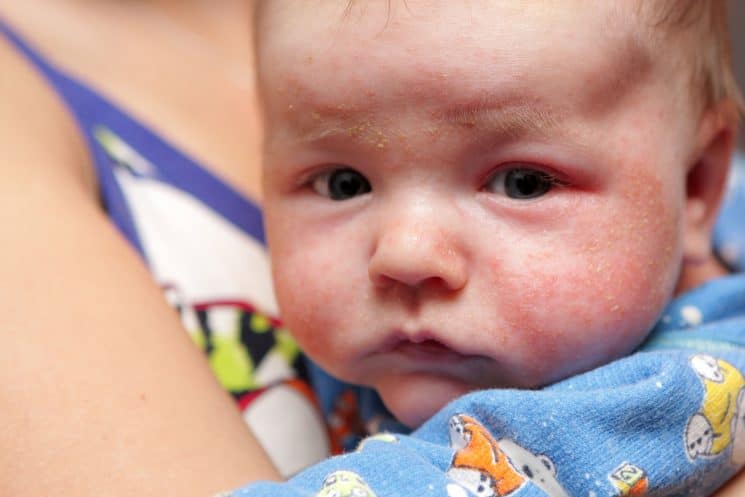 Kids and Eczema: Everything You Need to Know. This is eczema on face of newborn.