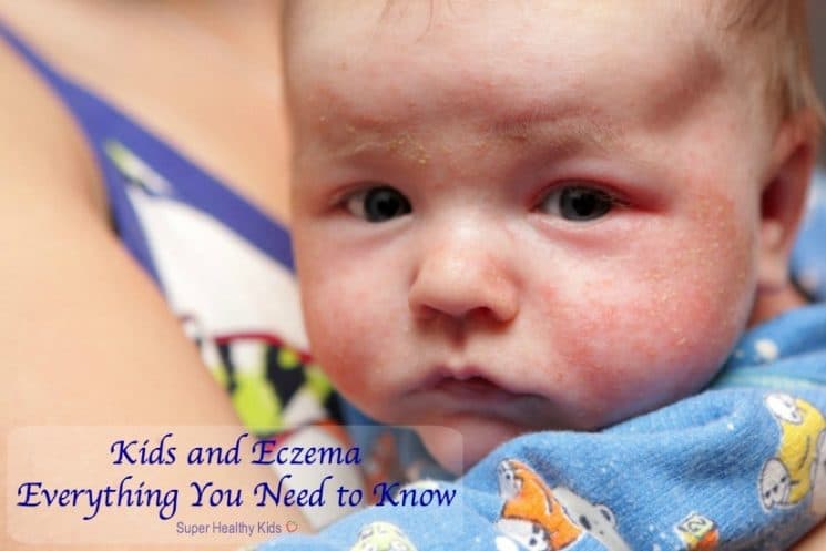Kids and Eczema: Everything You Need to Know. This is eczema on face of newborn. https://www.superhealthykids.com/kids-and-eczema-everything-you-need-to-know/