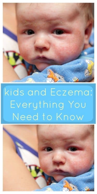 ids and Eczema: Everything You Need to Know