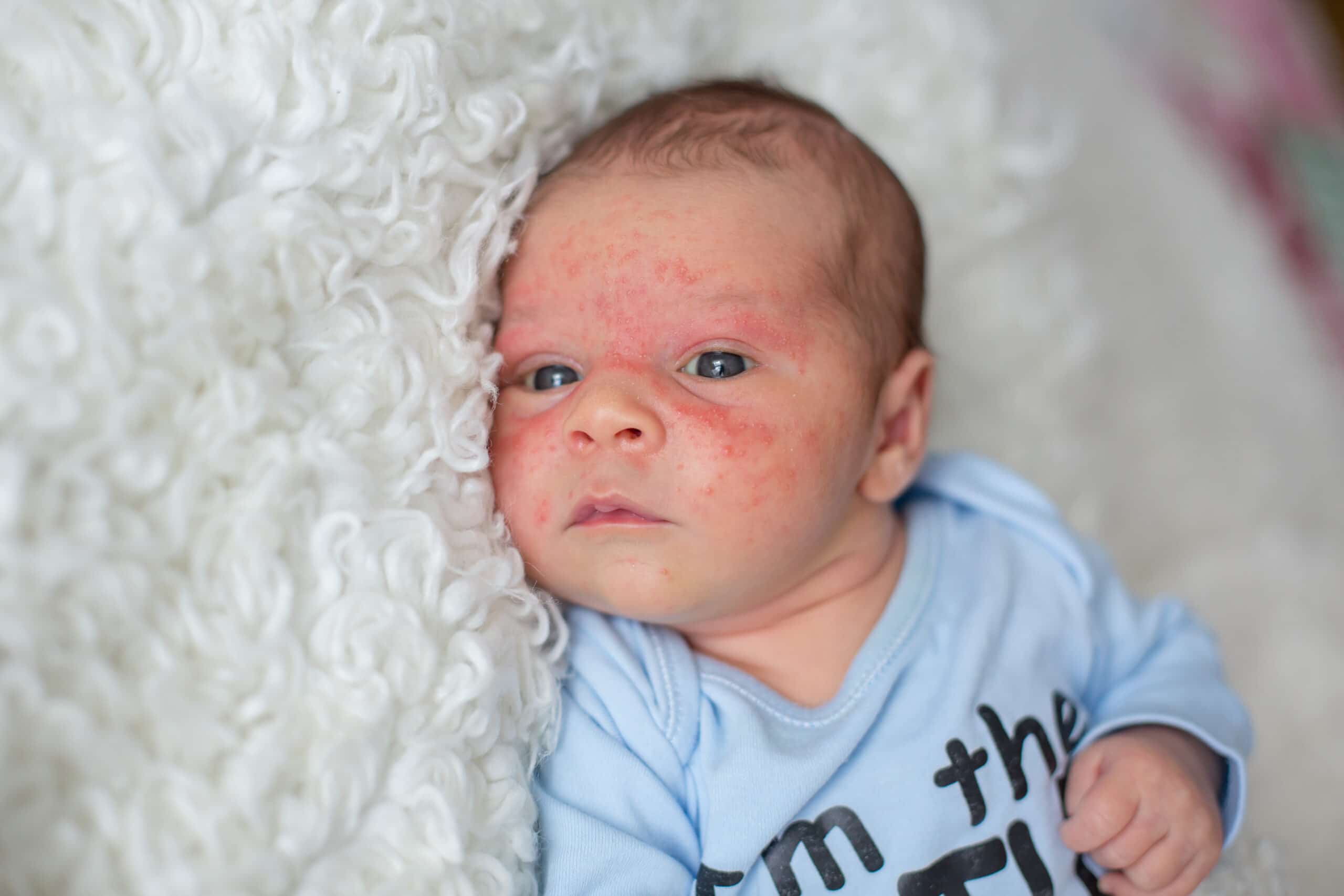 when does newborn acne start