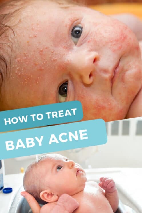 best lotion for baby acne